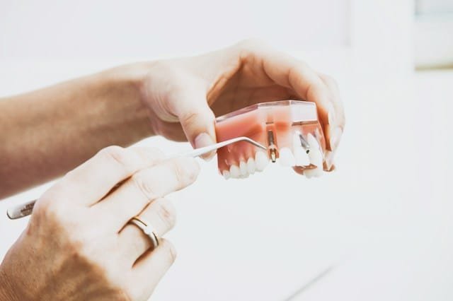 cuanto duran los implantes dentales